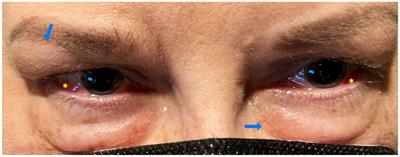 The full range of ophthalmological clinical manifestations in systemic lupus erythematosus